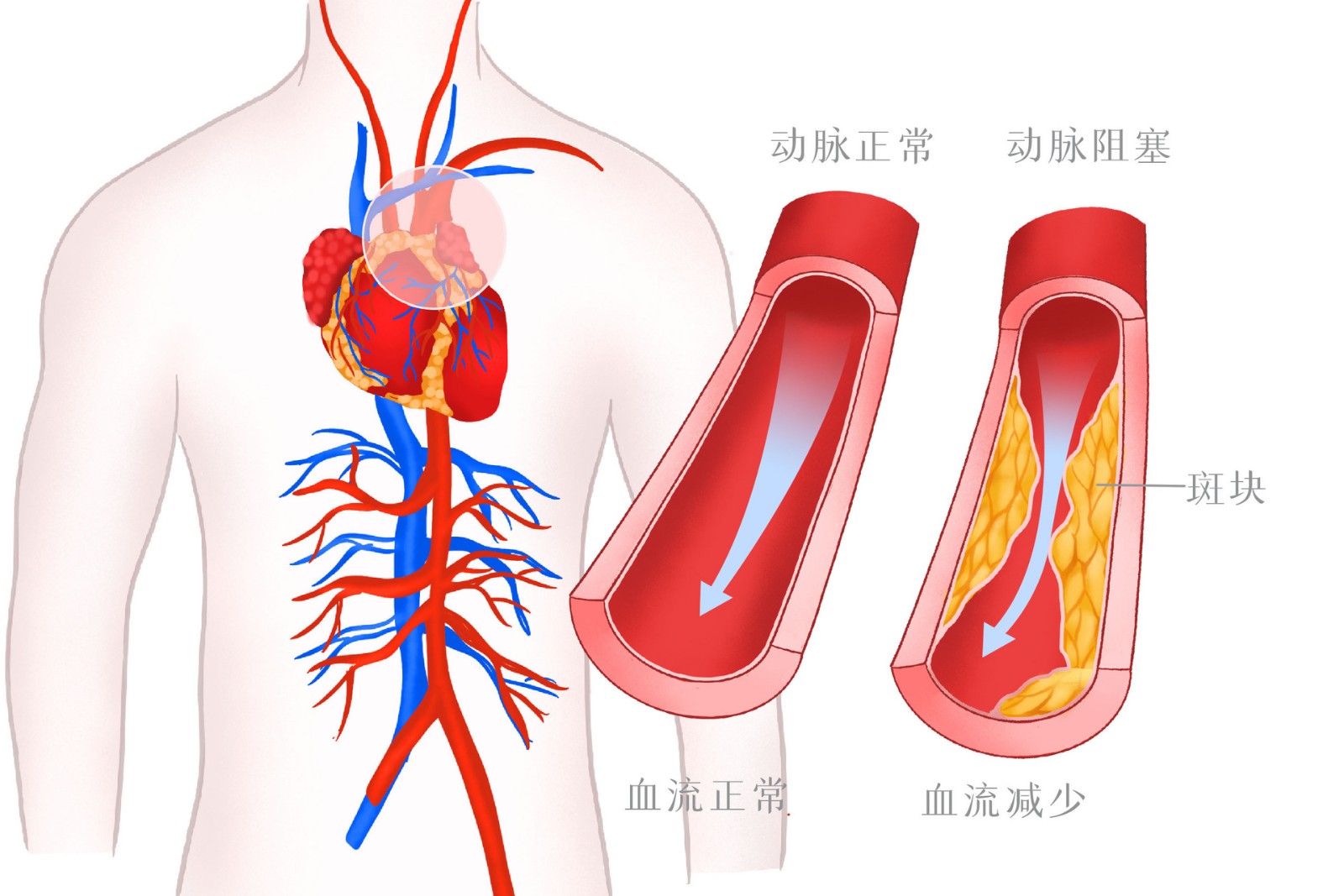 攝圖網_401802186_高血壓血管病變醫療插畫(企業商用).jpg